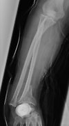 Local anaesthetics are widely used by anaesthesiologists, surgeons or general practitioners. There...