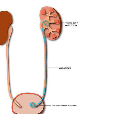 Krvácení do trávicího traktu jako hlavní příznak  těžké urosepse