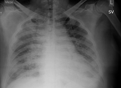 Letální průběh sepse při pneumonii u morbidně obézního pacienta