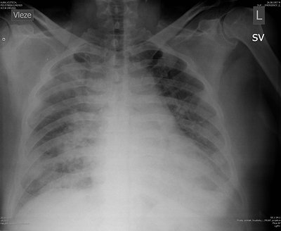 Urosepse s nasedající bronchopneumonií