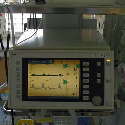 Sepse při peritonitidě - subhepatální absces